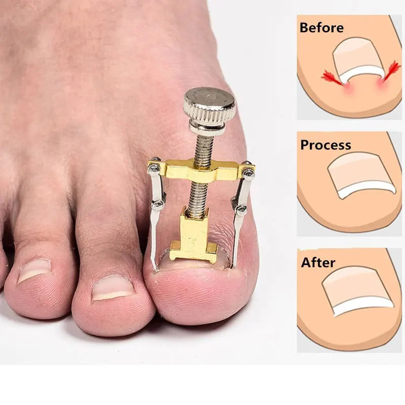 Correction of Paronychia with Toe Nail Correction Bracket for Treatment of Toe and Toe Care with Toe Fixator